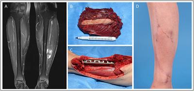 Efficacy and Safety of Microsurgery in Interdisciplinary Treatment of Sarcoma Affecting the Bone